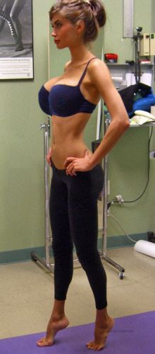 Morphed pic, she´s an amateur girl. According several post on reddit she´s been treated for scoliosis 